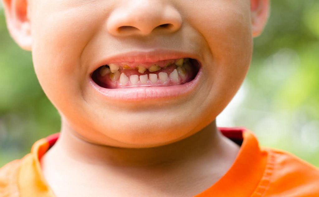 Kerusakan Gigi Anak Sedang Meningkat