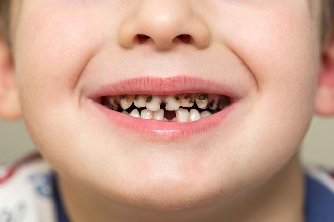 Ini Dia Tujuh Penyebab Gigi Kita Bisa Ompong